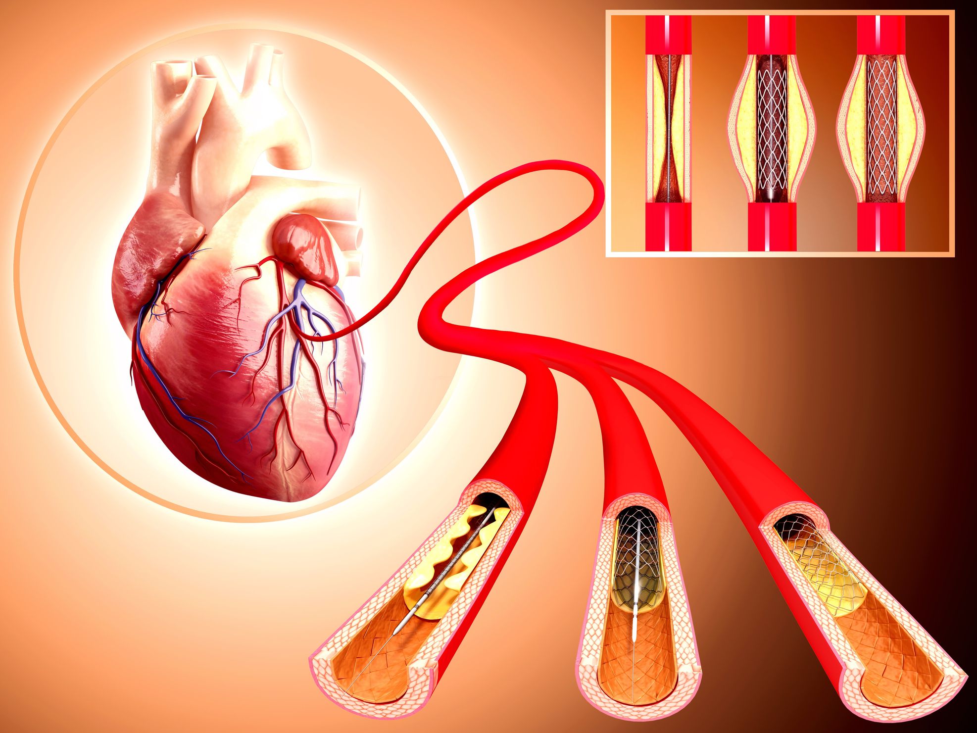 The Survival Rate After Stent Placement Health Living Advocate