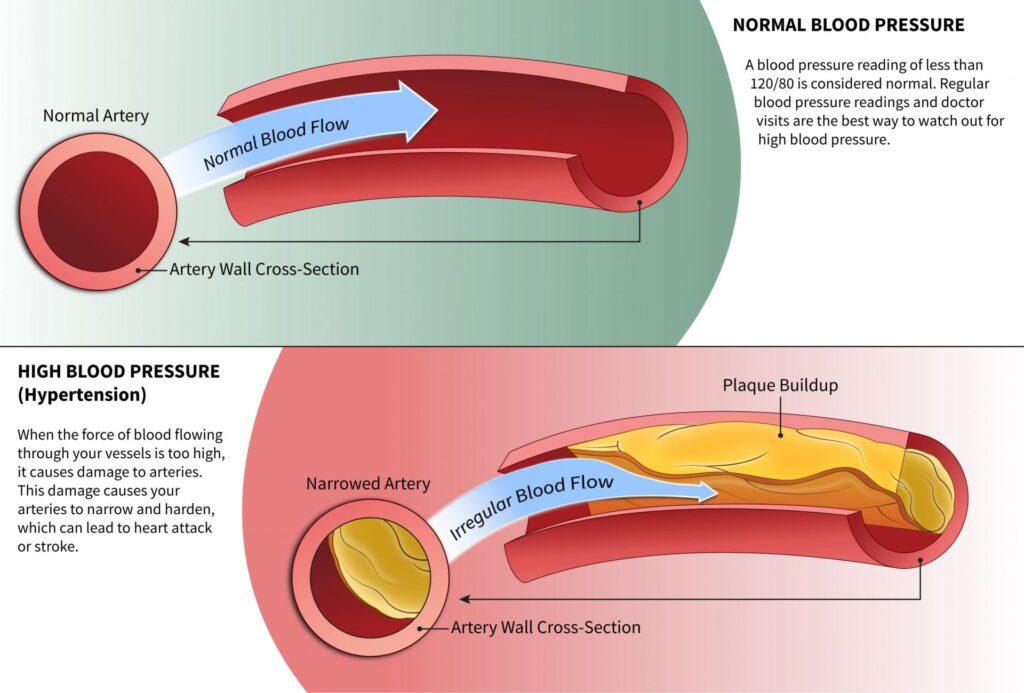 Can High Blood Pressure Cause Erectile Dysfunction 