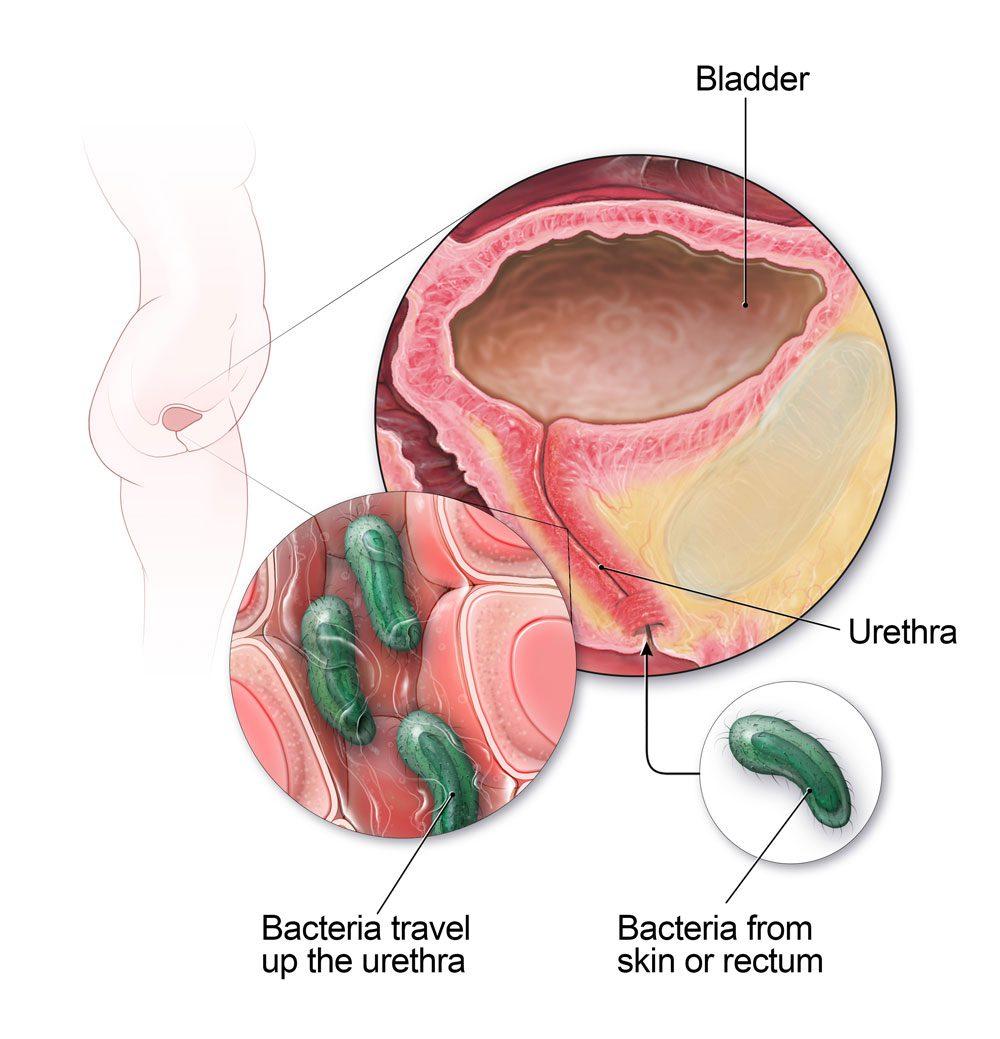 how-does-a-urinary-tract-infection-uti-make-you-feel