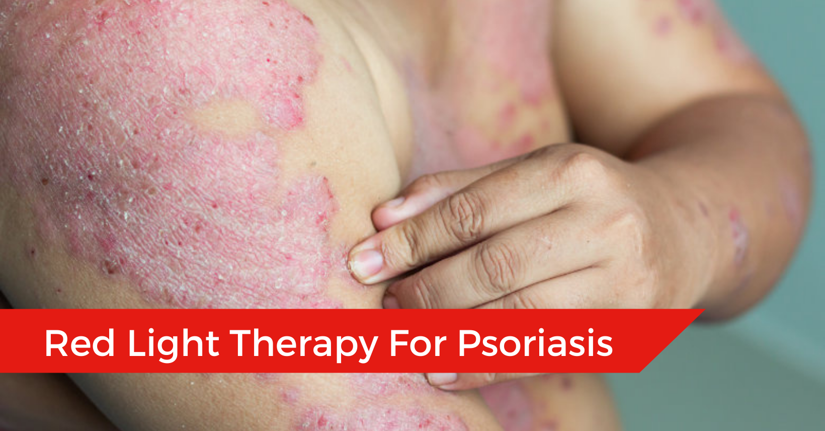 can red light therapy help psoriasis