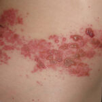 what are shingles a complete guide